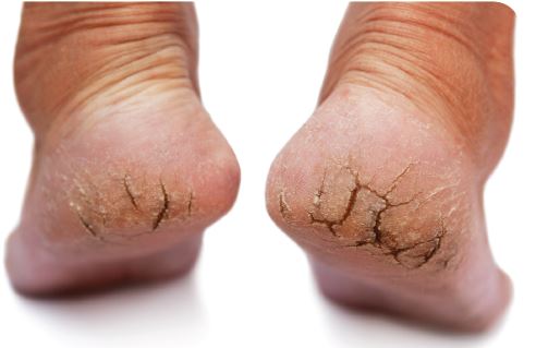 cracked heels